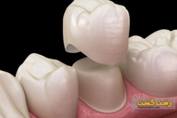 علت و درمان عفونت دندان روکش شده 