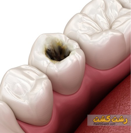 تصویر شماره علت و درمان عفونت دندان روکش شده 