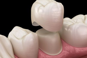 علت و درمان عفونت دندان روکش شده 
