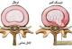 دیسک کمر در بارداری