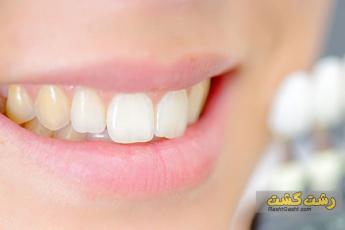 زرد شدن دندان