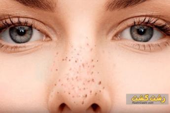 پلاژن تراپی