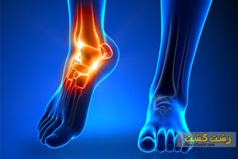 جراحی آرتروز پا