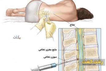 تفاوت بی حسی اپیدورال و اسپاینال