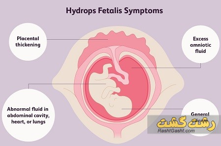تصویر شماره هیدروپس جنینی چیست ؟