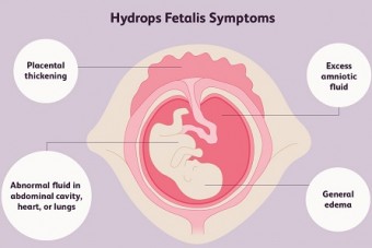 هیدروپس جنینی چیست ؟