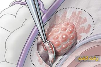 مننژیوم یا تومور مغزی